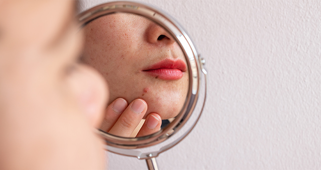 Acne vs Pimples Decoded: How They’re Different And Ways To Reduce Both